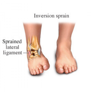 Inversion sprain