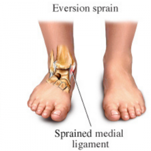 Eversion sprain