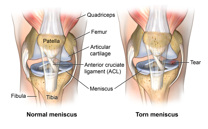 Normal And Torn Meniscus